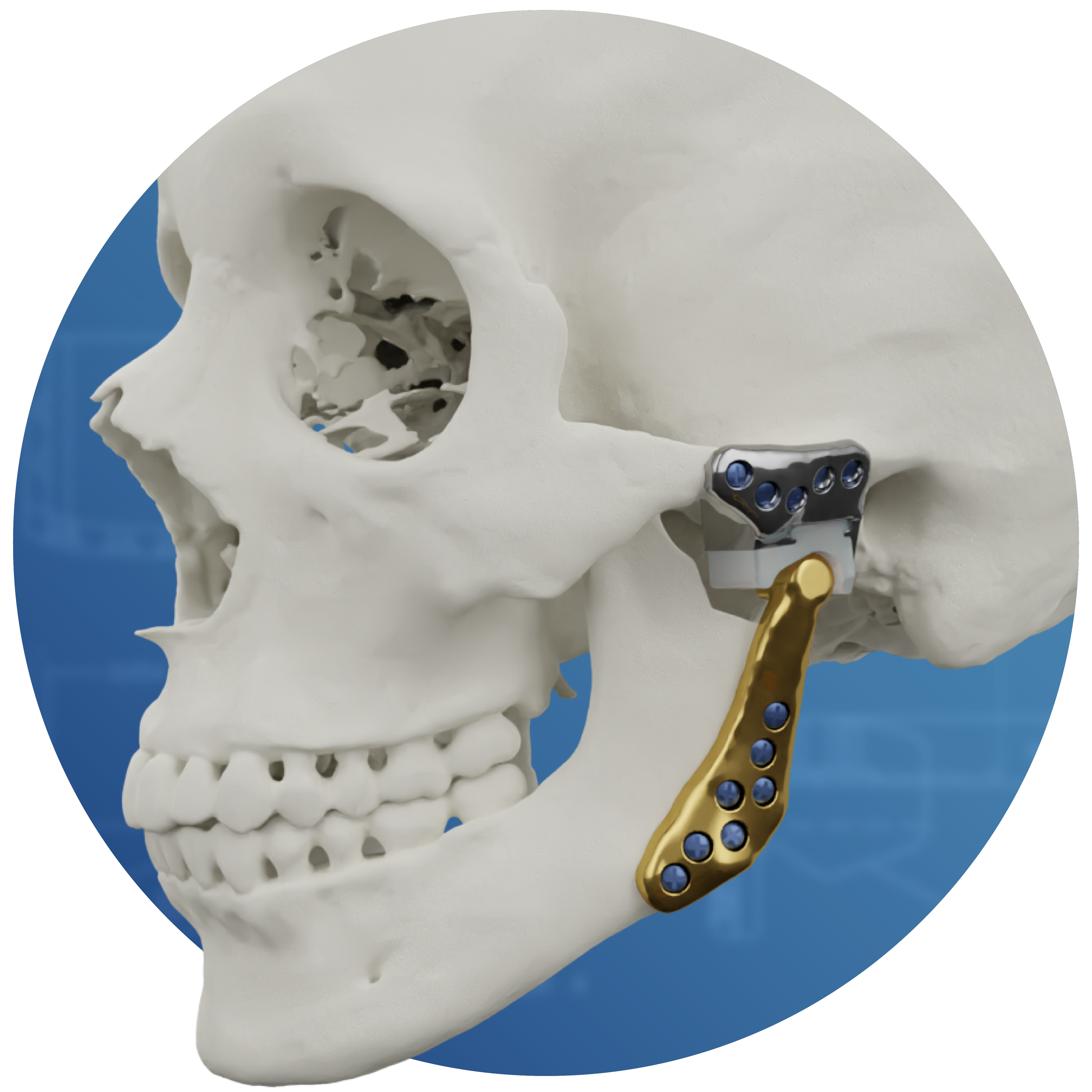OrthoTiN TMJ system